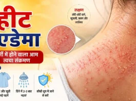 heat-edema-symptoms-causes-treatment-hindi