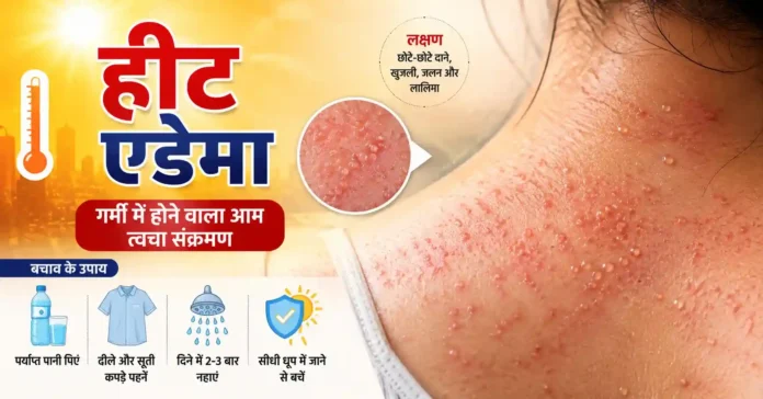 heat-edema-symptoms-causes-treatment-hindi